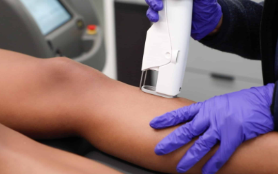 Bikini Line Or Full Coverage: Which Laser Treatment Actually Fits Your Goals?